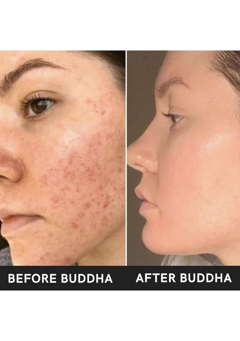 Buddha Natural Acne Ubtan 50 Gms 100 Percent Ayush Certified Help with Acne Prone Exfoliate and Skin Breakouts - Indya