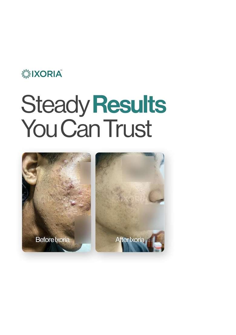 Ixoria Anti Acne Face Mask for Pimples Ayurvedic Herbal Face Pack for Oily and Acne Prone Skin - Indya