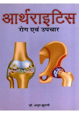 Arthritis Disease and Treatment