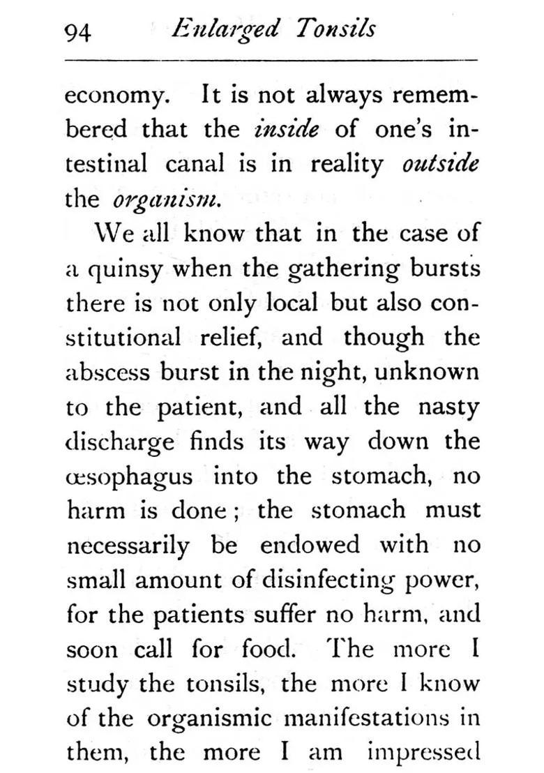 Enlarged Tonsils Cured by Homoeopathy - Indya