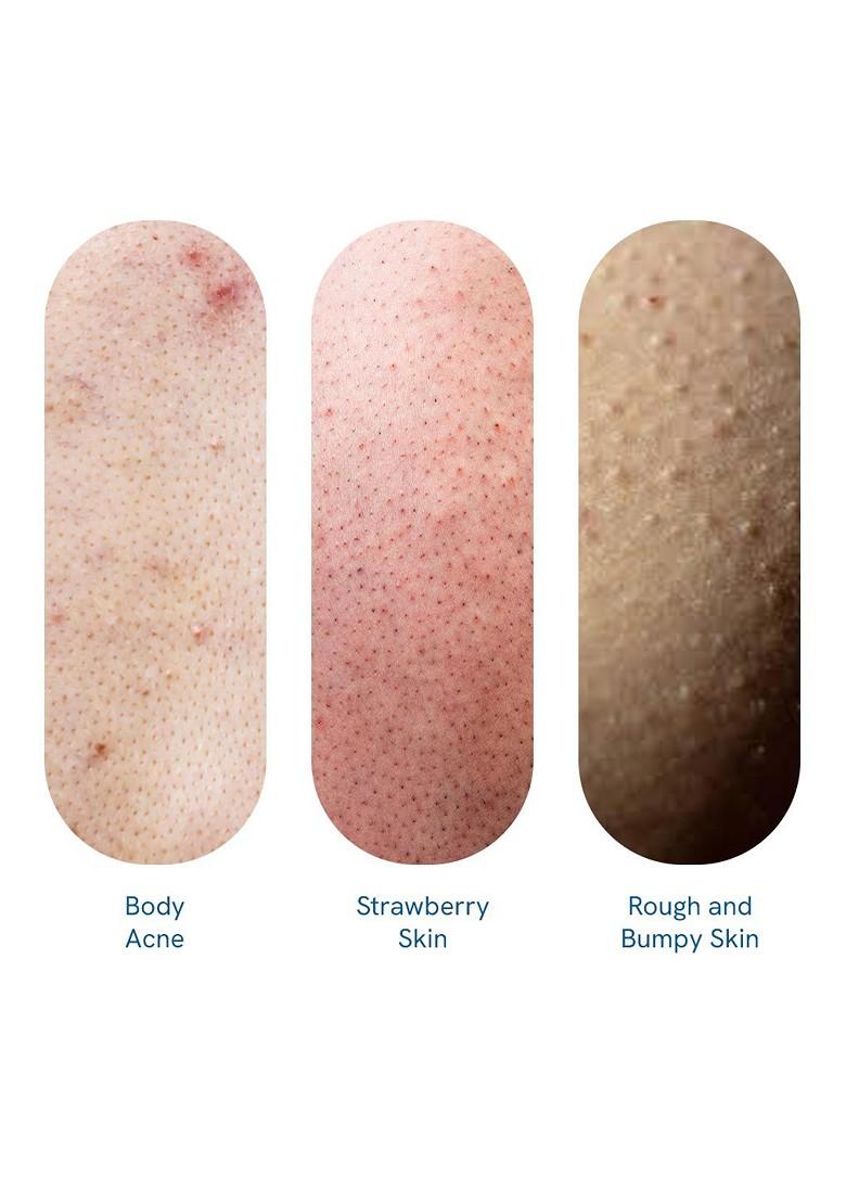 Be Bodywise 1 Salicylic Acid Body Wash To Prevent Acne Exfoliate Dead Skin 250Ml