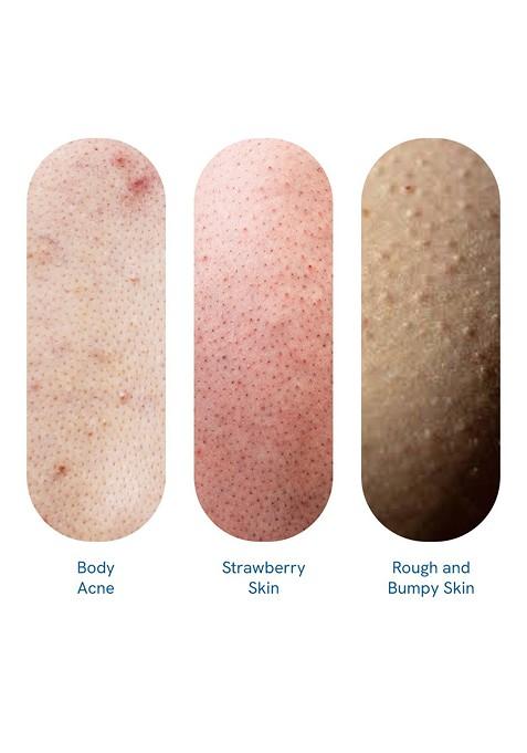 Be Bodywise 1 Salicylic Acid Body Wash Prevents Acne Exfoliate Dead Skin 100Ml